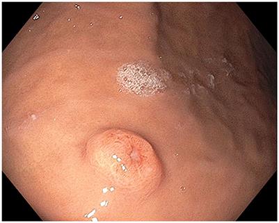 Gastric and colonic metastases of malignant melanoma diagnosed during endoscopic evaluation of symptomatic anemia presenting as angina: a case report